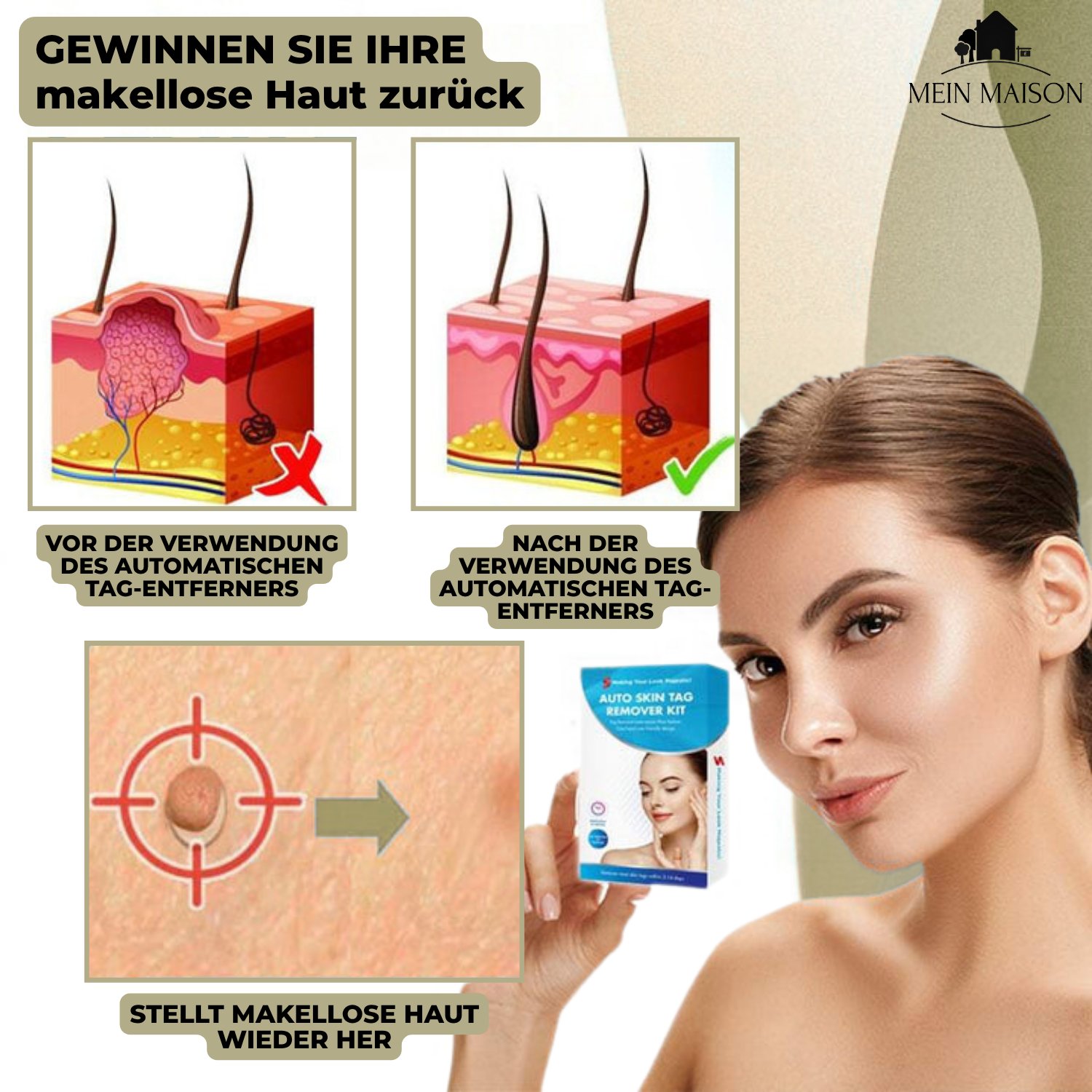 DermaLinx Wrattenverwijderaar | Pijnloze Verwijdering van Wratten & Moedervlekken | Voor Thuis | Zonder Operatie 4
