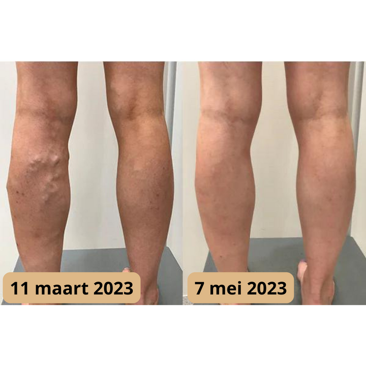 Lymfomat | Acupunctuurpunten-therapie voor een betere doorbloeding 6