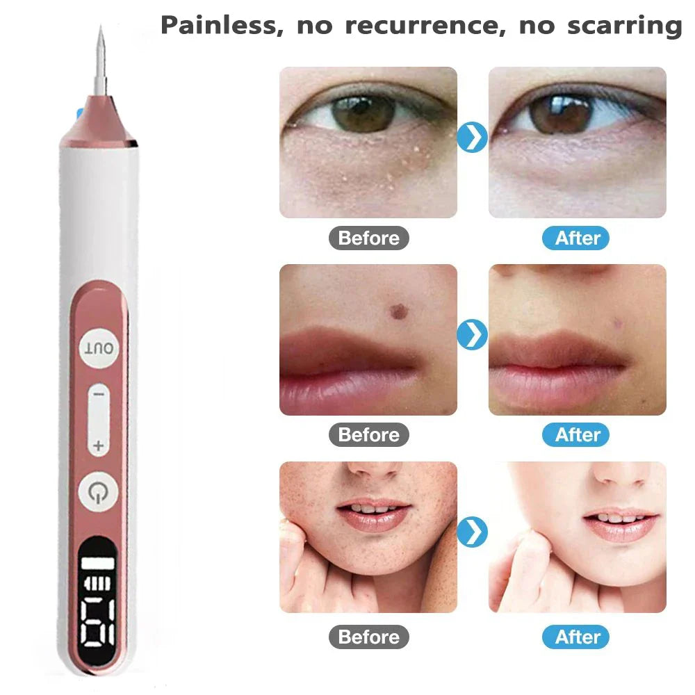 ClearSkin Rimuovi Macchie – Indolore & Efficace per Casa